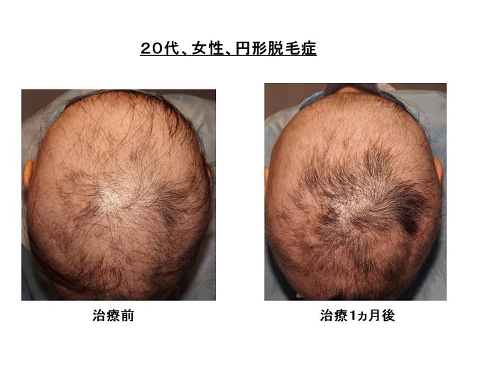 円形脱毛症　病院""